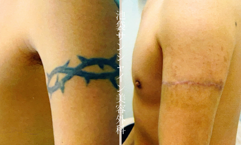 左上腕 とげ のタトゥ除去 before after
