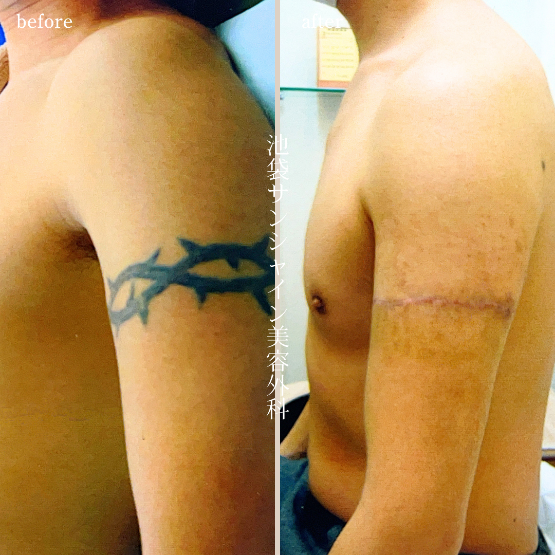 左上腕 とげ のタトゥ除去 before after