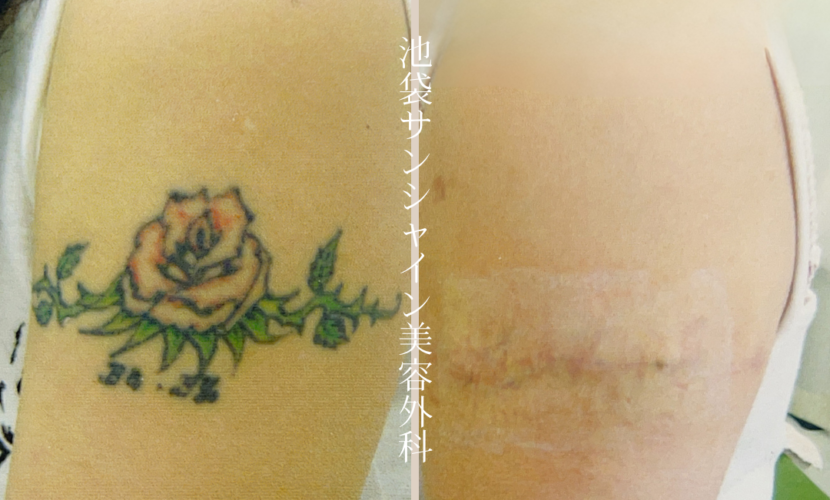 左上腕 バラのタトゥー除去 before after