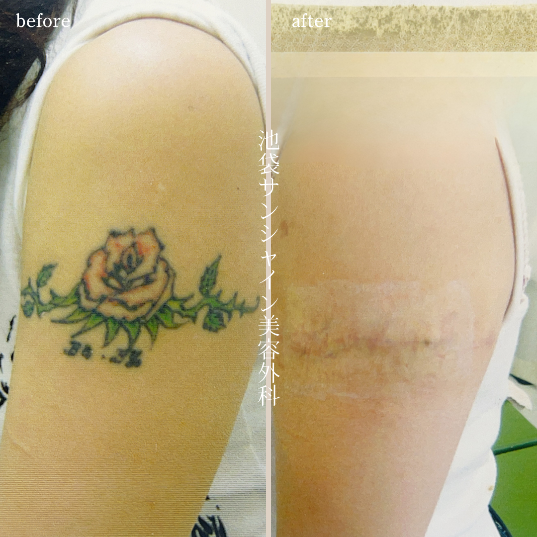 左上腕 バラのタトゥー除去 before after