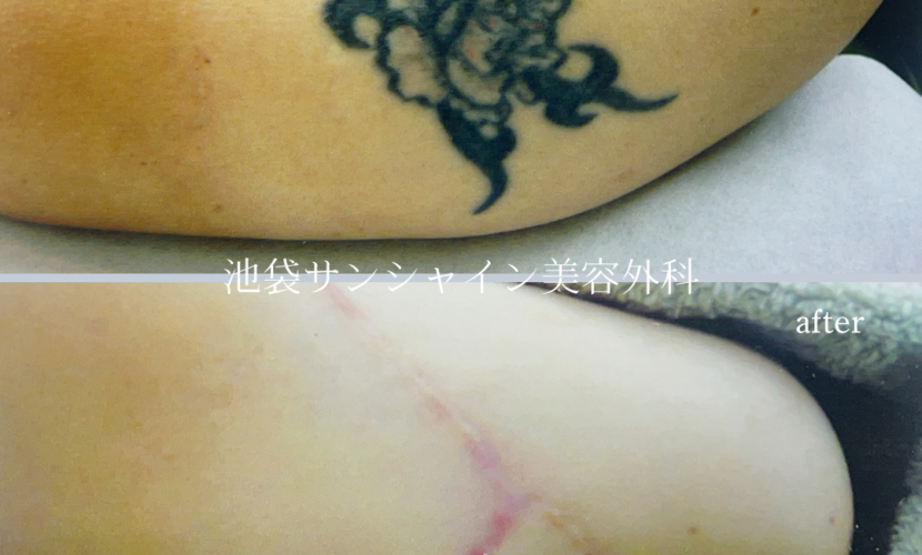 左上腕 花のタトゥ除去 before after