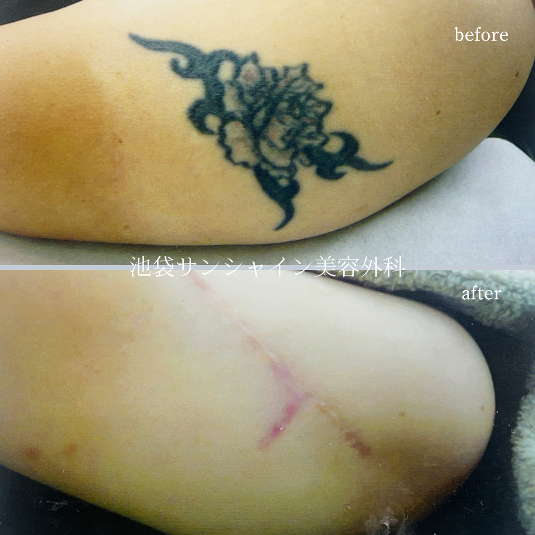 左上腕 花のタトゥ除去 before after