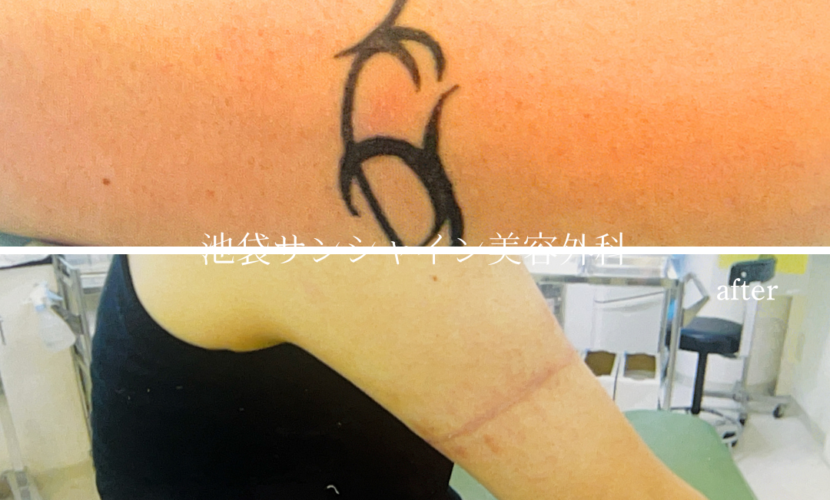 左上腕の タトゥ除去 男性 before after