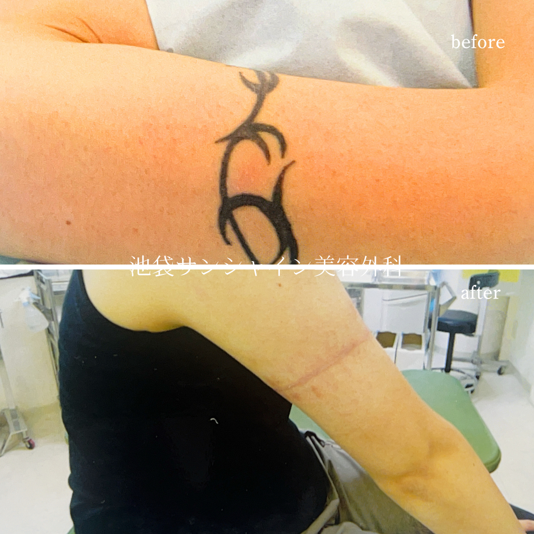 左上腕の タトゥ除去 男性 before after