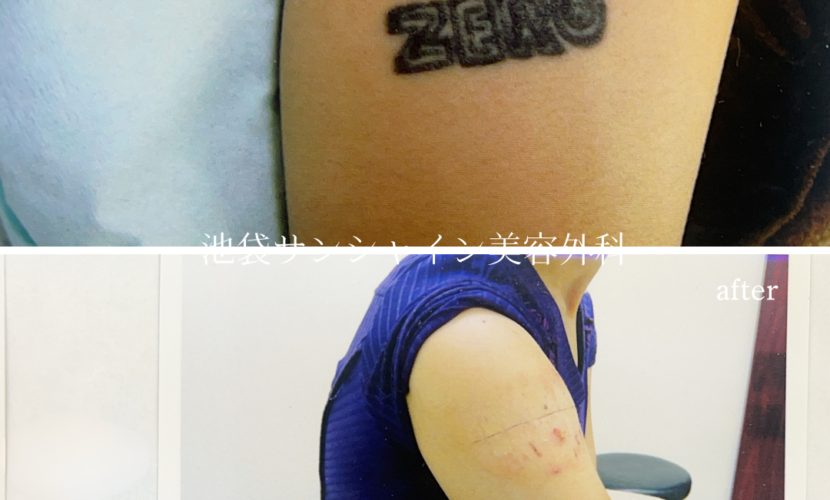 左上腕のZERO タトゥ除去 before after