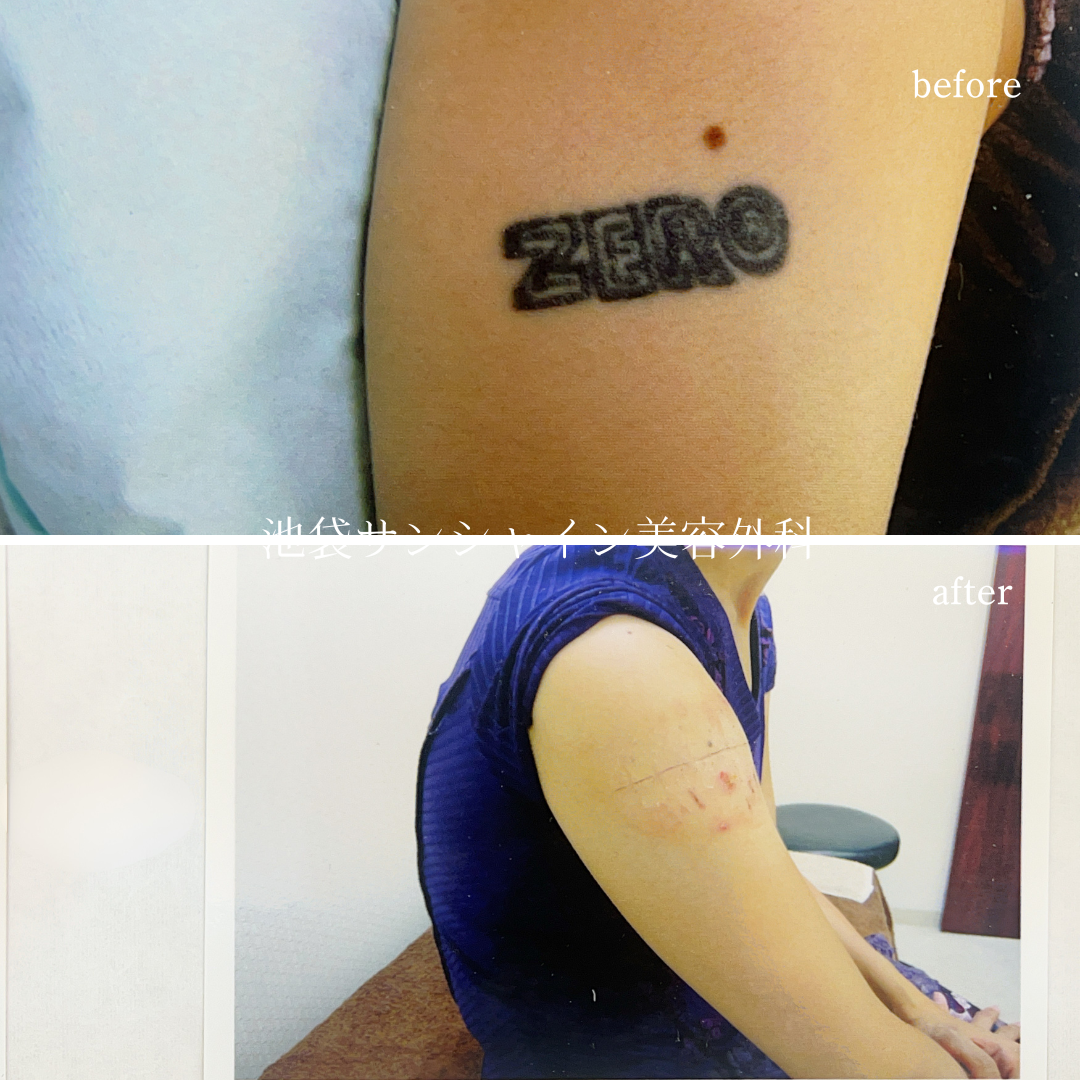左上腕のZERO タトゥ除去 before after