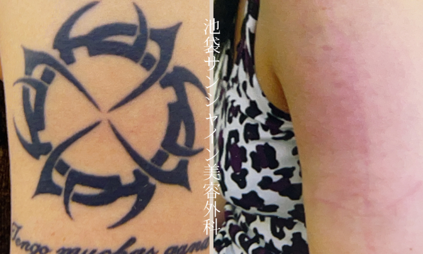 左上腕のタトゥー除去 女性 before after