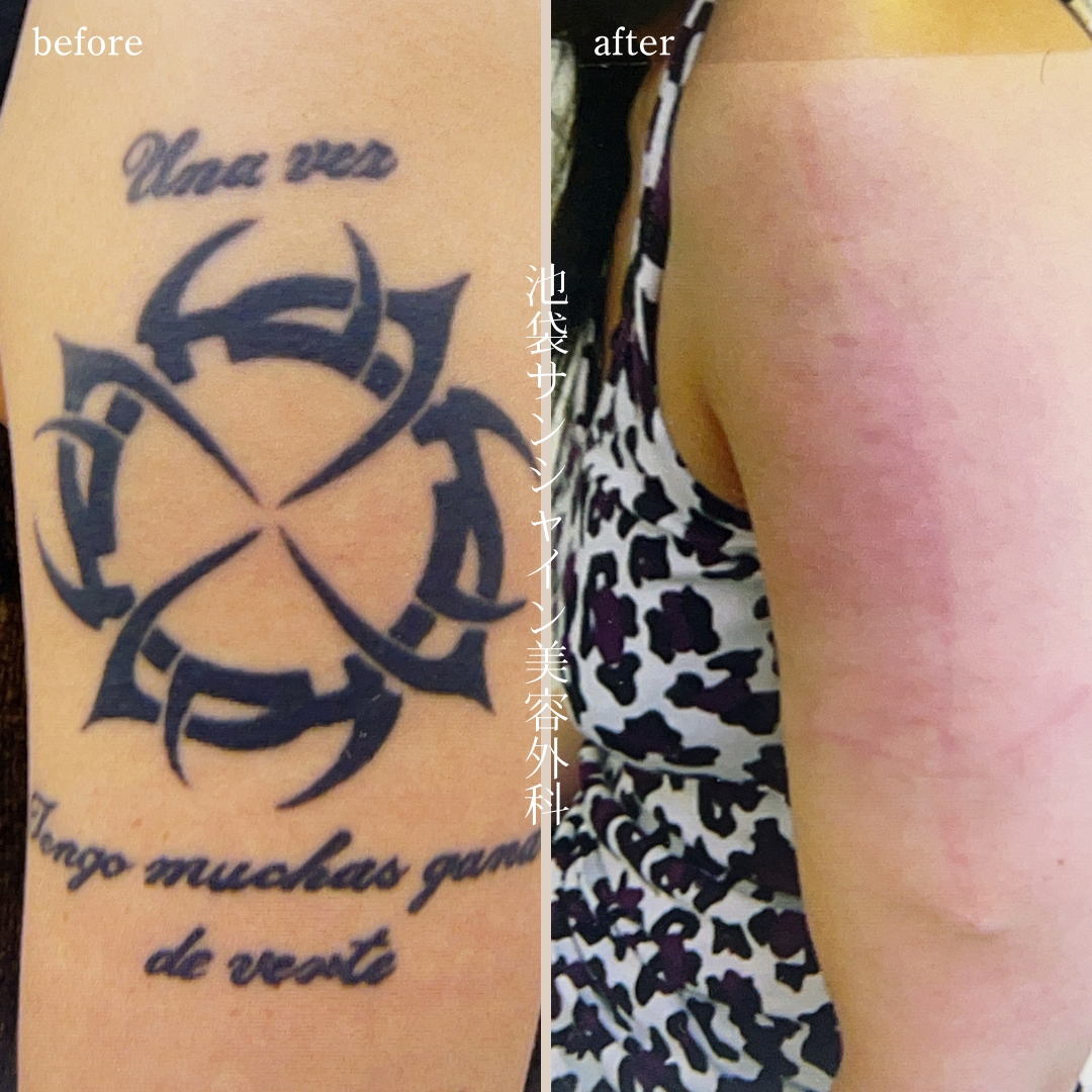 左上腕のタトゥー除去 女性 before after