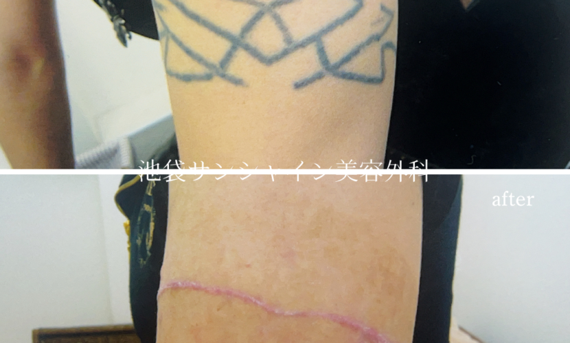 左上腕タトゥ除去 男性 before after