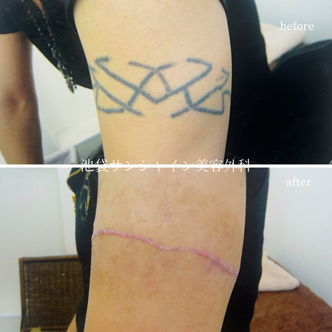 左上腕タトゥ除去 男性 before after