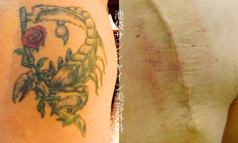 左上腕バラのタトゥー除去 before after