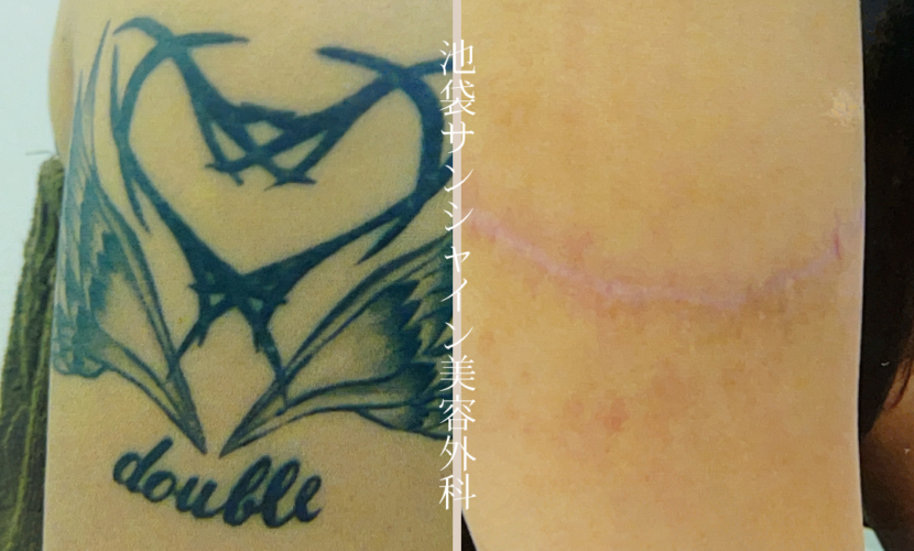 左腕 double のタトゥ除去 before after