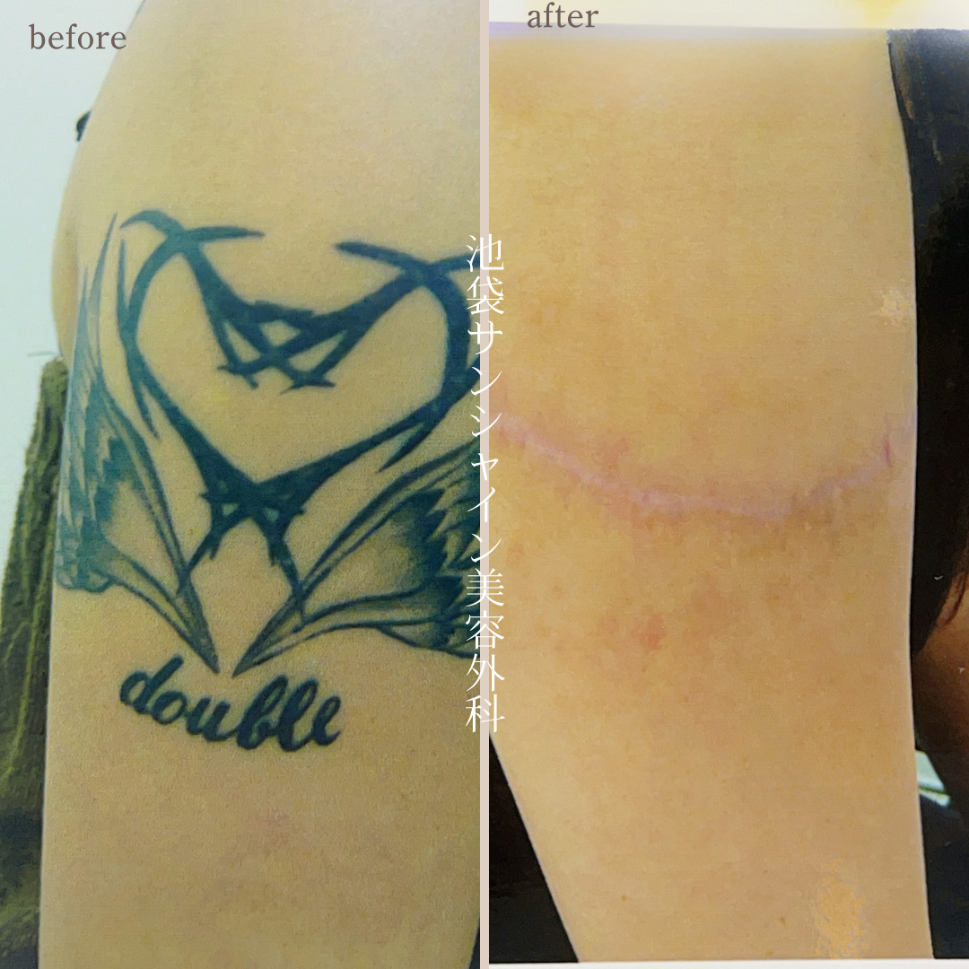 左腕 double のタトゥ除去 before after