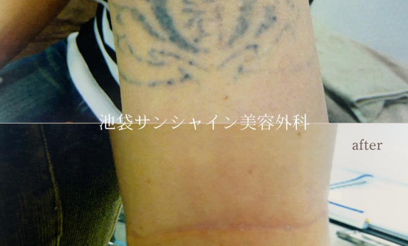左腕 ハート のタトゥ除去 before after