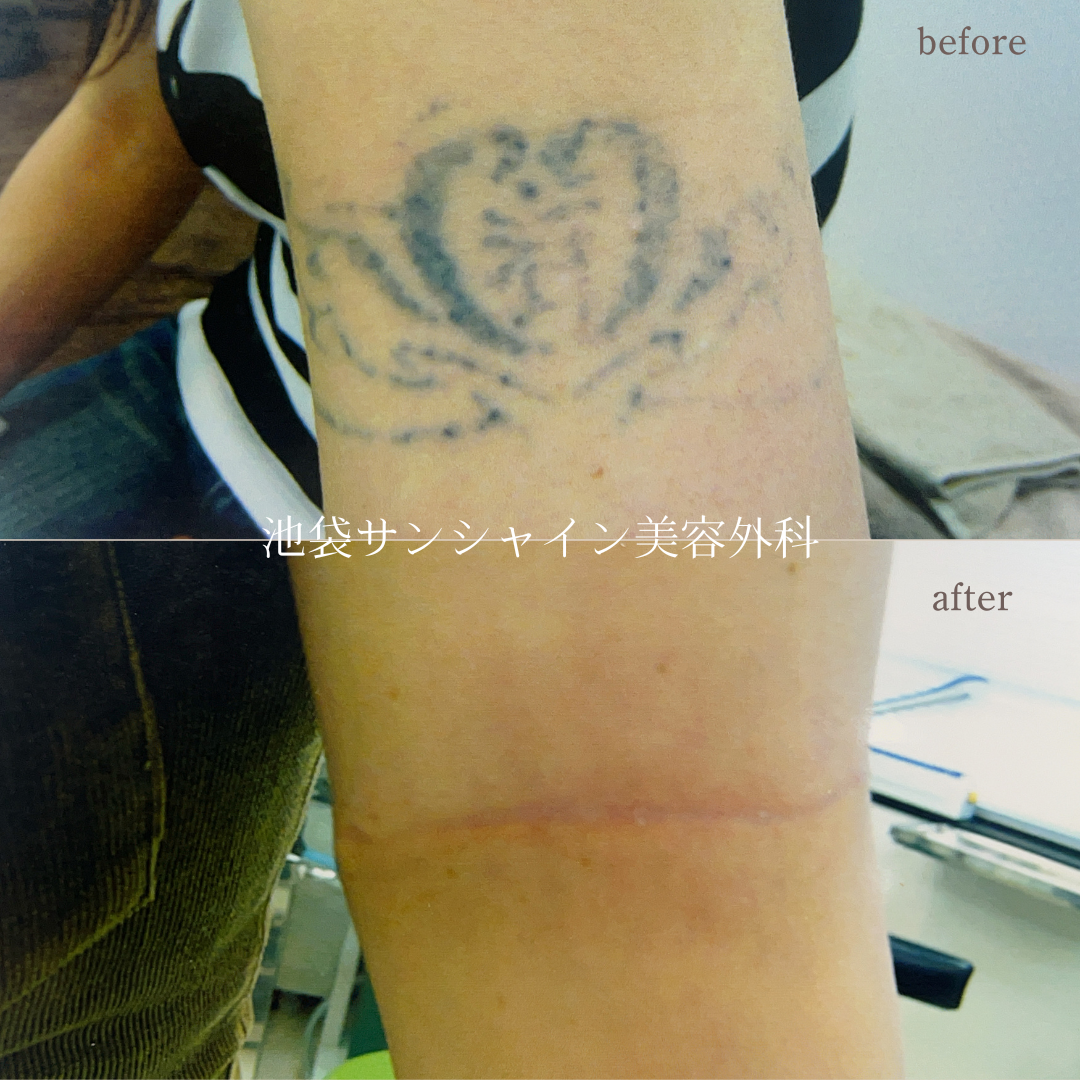 左腕 ハート のタトゥ除去 before after
