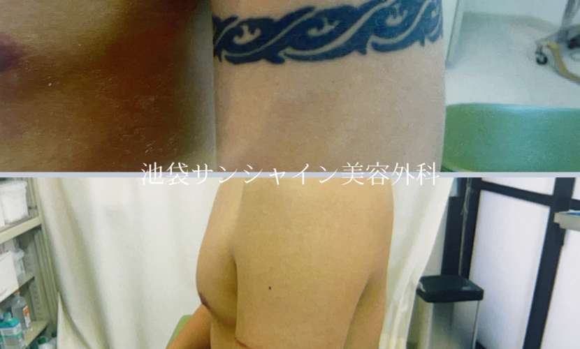 左腕のタトゥ除去 男性 before after