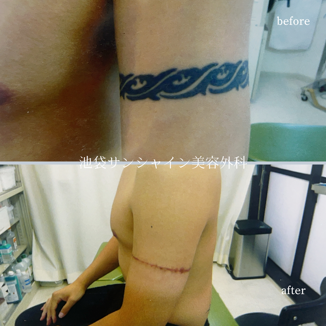 左腕のタトゥ除去 男性 before after