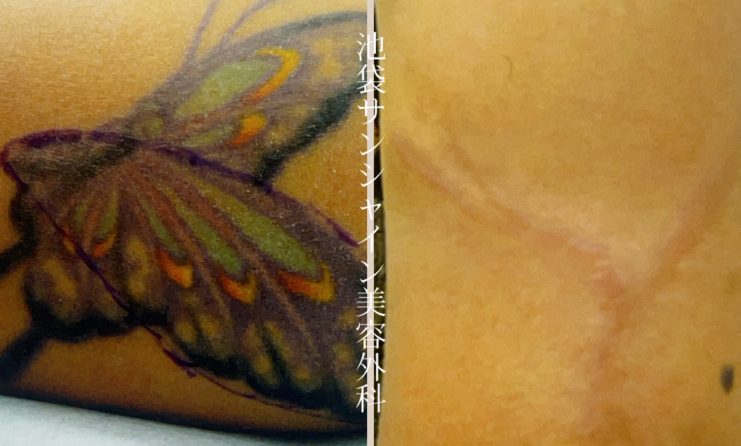 左腕アゲハ蝶のタトゥ除去 before after