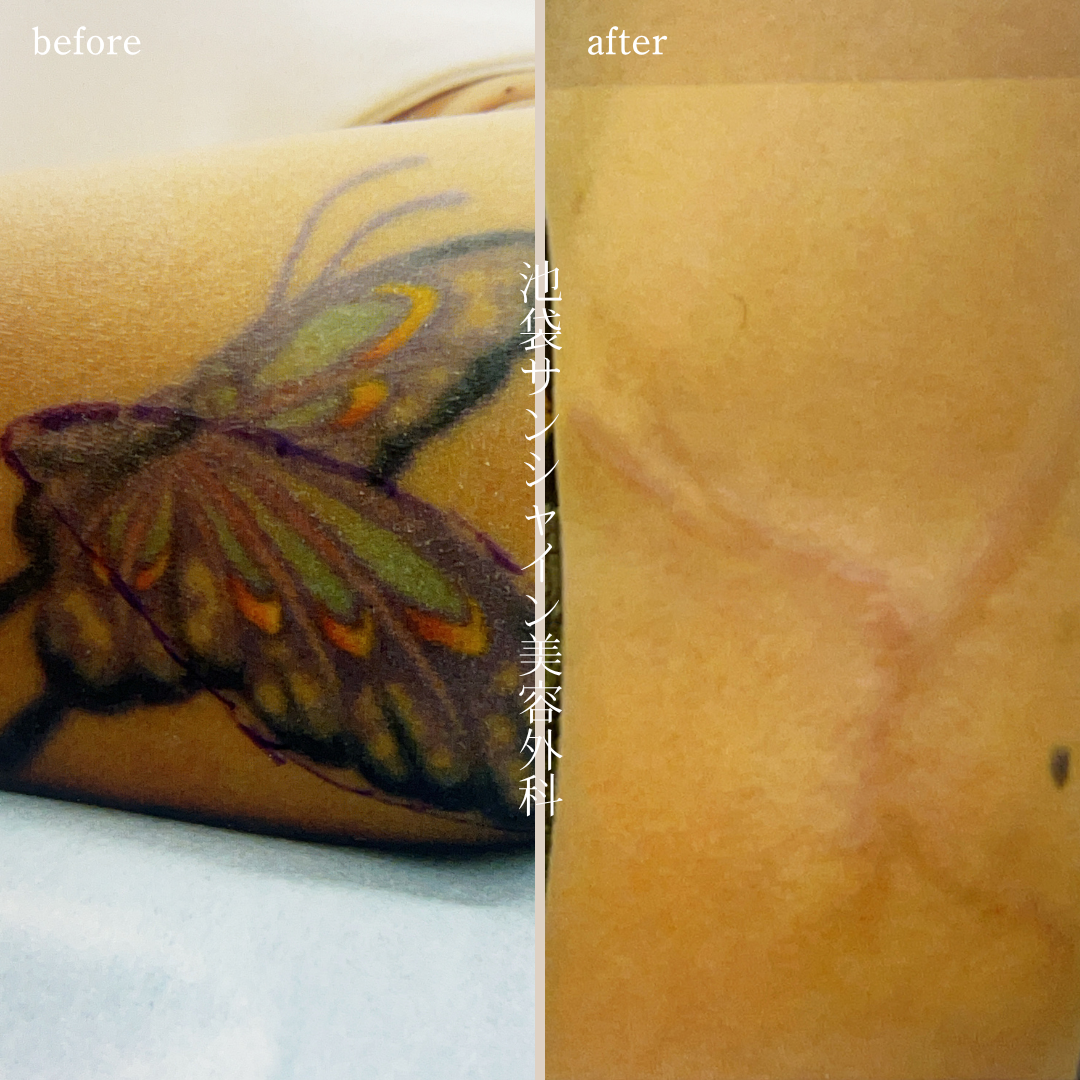 左腕アゲハ蝶のタトゥ除去 before after