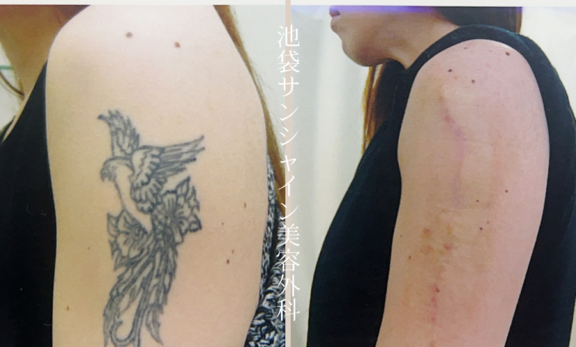 左腕鳥のタトゥ除去 before after