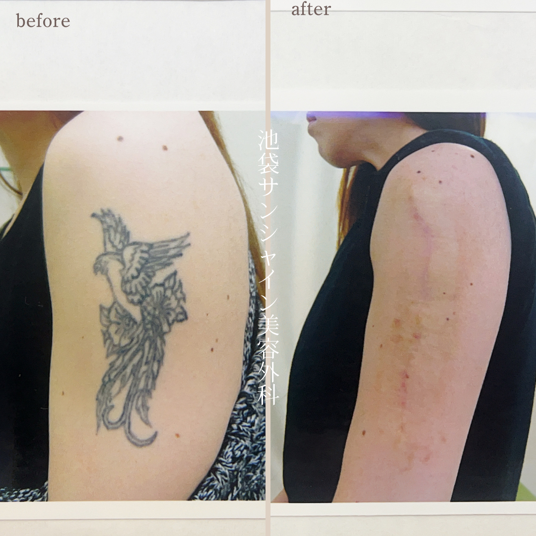 左腕鳥のタトゥ除去 before after