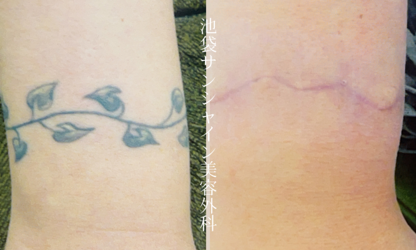 手首葉 のタトゥ除去 before after