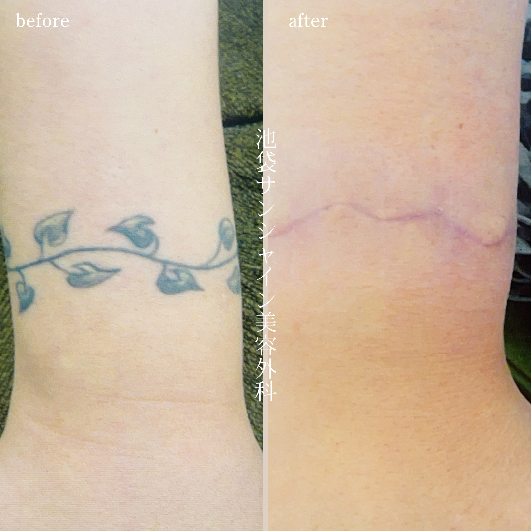 手首葉 のタトゥ除去 before after
