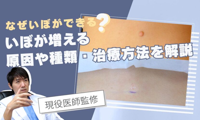 いぼが増える、原因や、種類。治療方法を解説