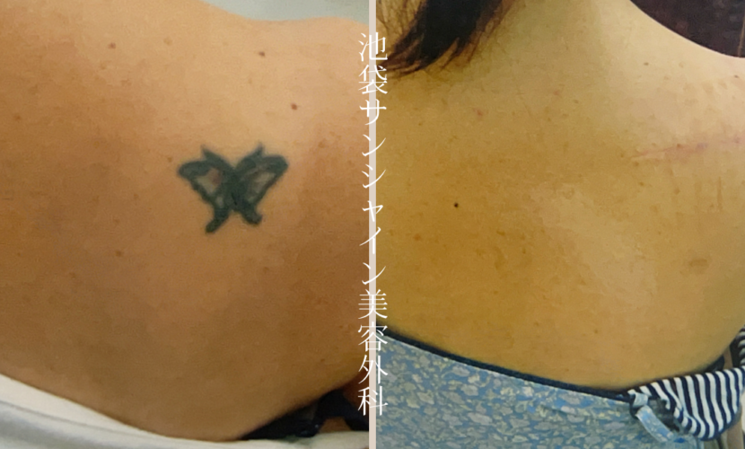右背中小さな蝶模様タトゥ除去 before after　