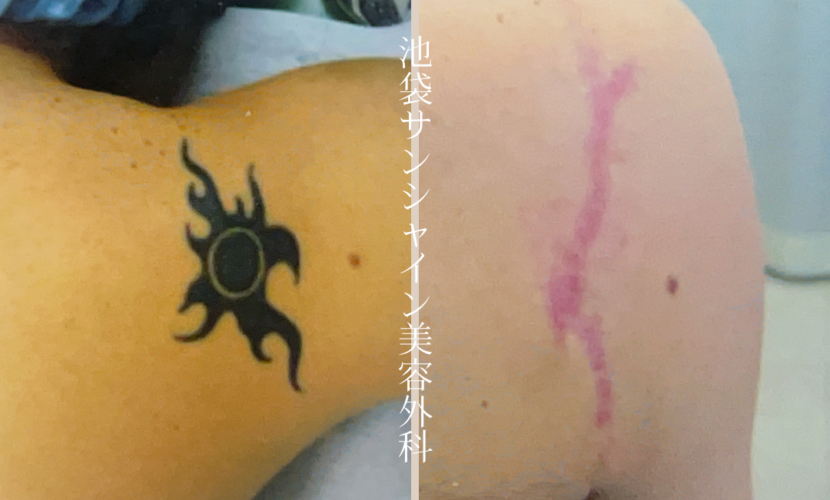 右背中模様除去 before after