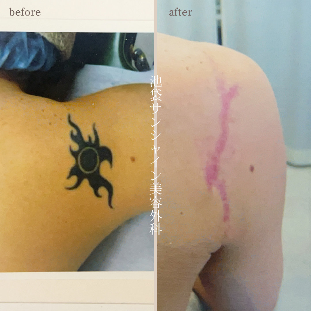 右背中模様除去 before after