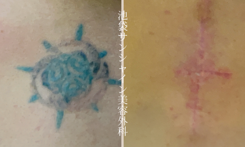右背中舵輪とバラ模様刺青除去 before after　