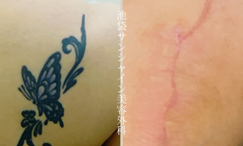 右背中蝶i刺青除去 before after　