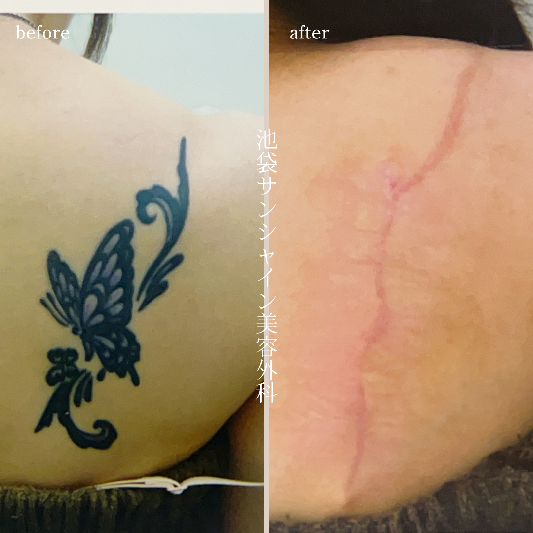右背中蝶i刺青除去 before after　