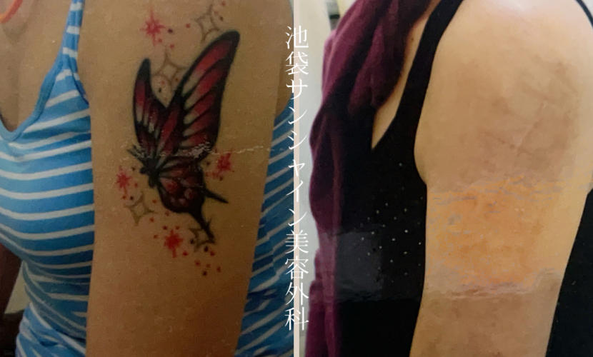 左上腕蝶、星模様 タトゥ除去 before after　