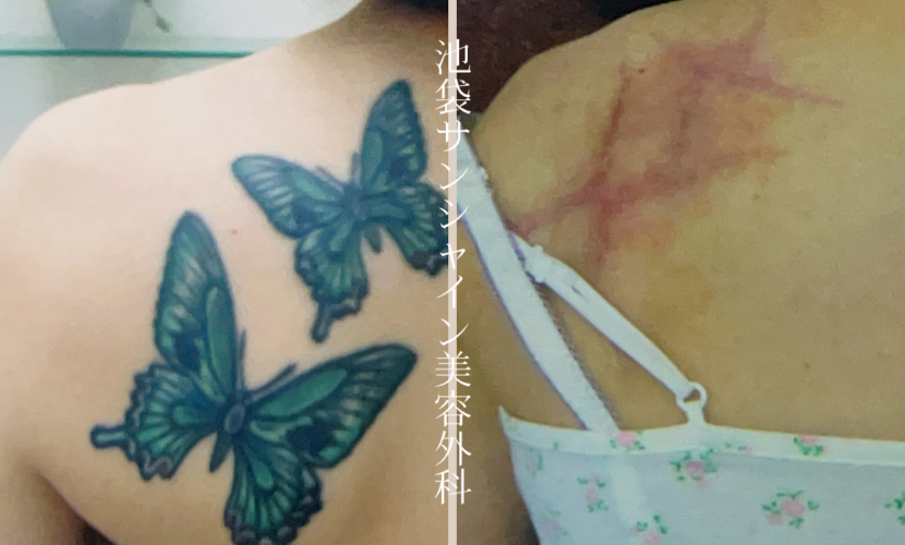 左背中2つのアゲハ蝶模様タトゥ除去 before after　