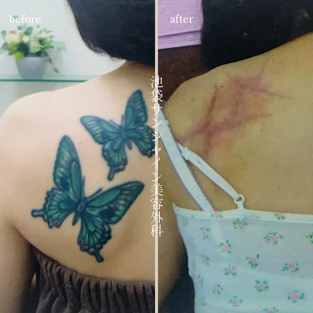 左背中2つのアゲハ蝶模様タトゥ除去 before after　