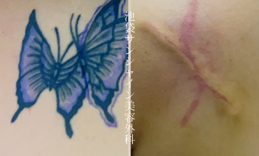 左背中2つの蝶模様タトゥ除去 before after　