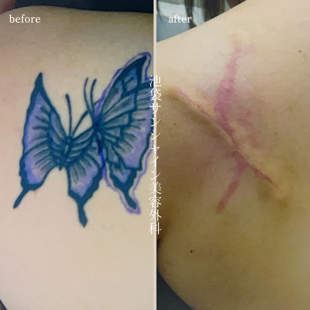 左背中2つの蝶模様タトゥ除去 before after　
