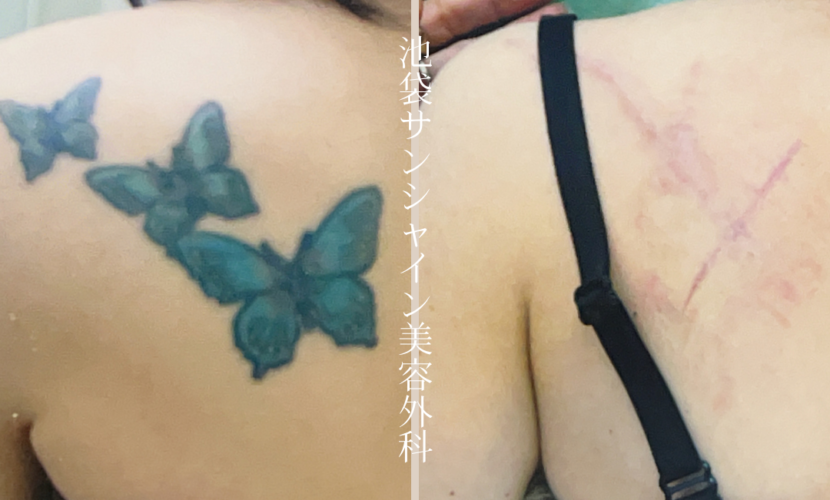左背中3つのアゲハ蝶模様タトゥ除去 before after　