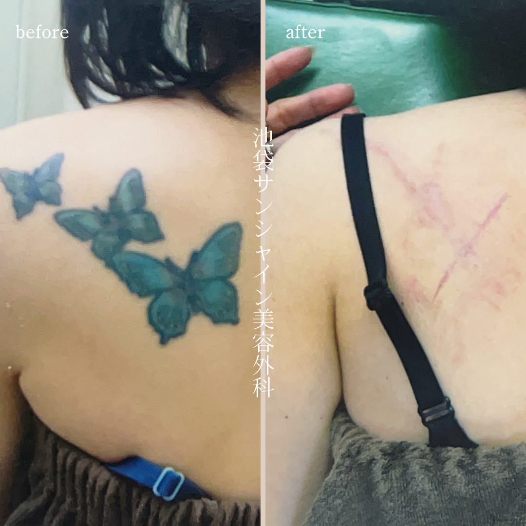 左背中3つのアゲハ蝶模様タトゥ除去 before after　