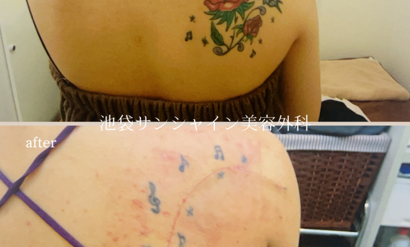 左背中バラと蝶模様タトゥ除去 before after　