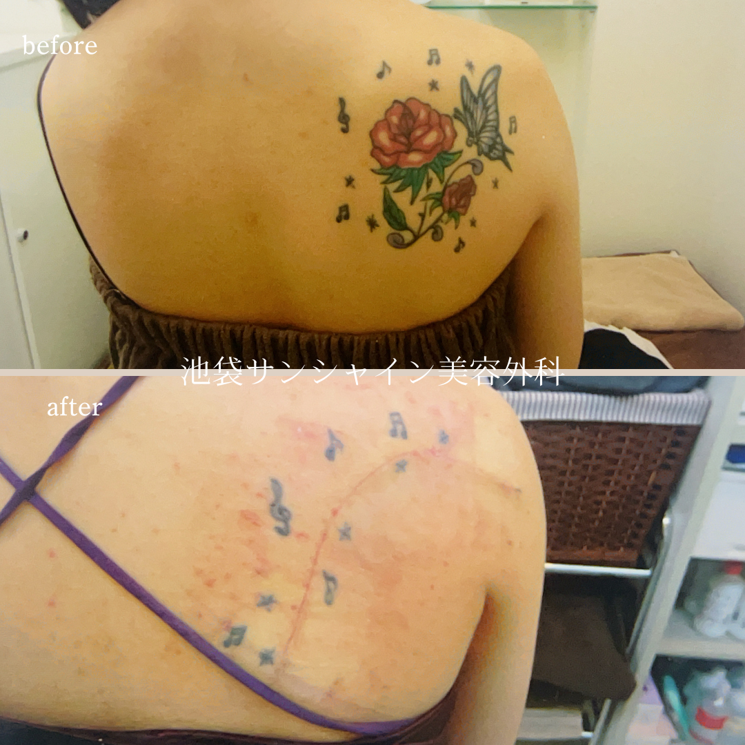 左背中バラと蝶模様タトゥ除去 before after　