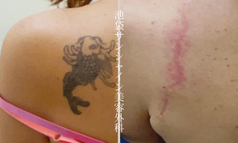 左背中人魚除去 before after　