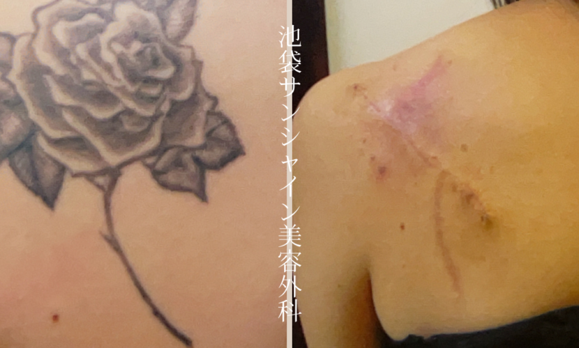 左背中大きなバラ模様タトゥ除去 before after