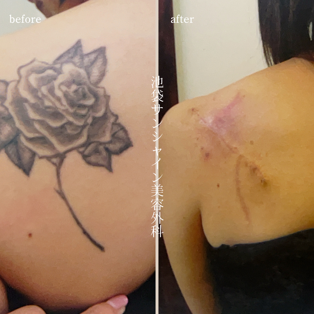 左背中大きなバラ模様タトゥ除去 before after