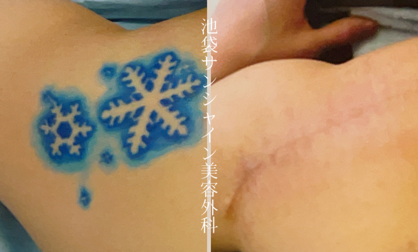 左背中氷模様刺青除去 before after　