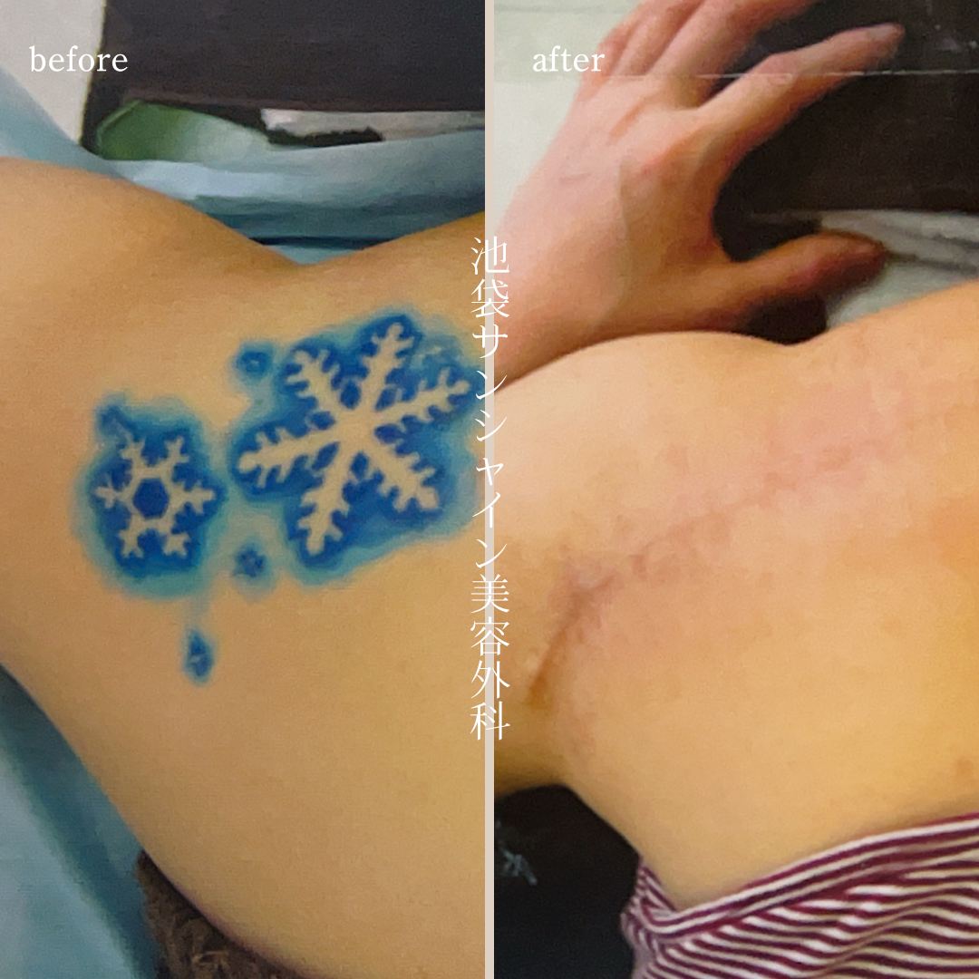 左背中氷模様刺青除去 before after　