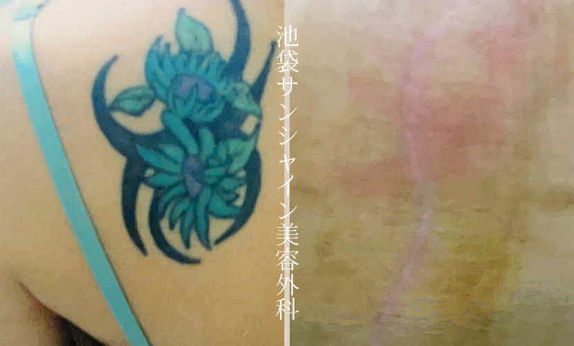 左背中花模様除去 before after　