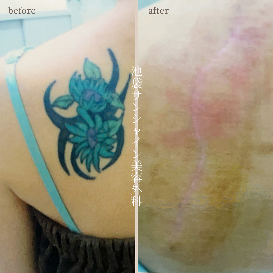 左背中花模様除去 before after　